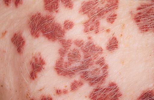 Vesikuläre Erkrankung